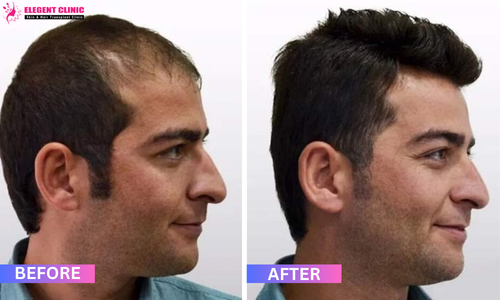 best hair transplant result in patna